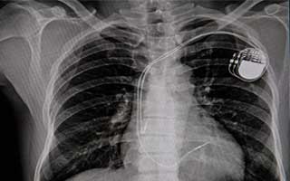 Magnetic Field Safety Guidelines for Pacemakers